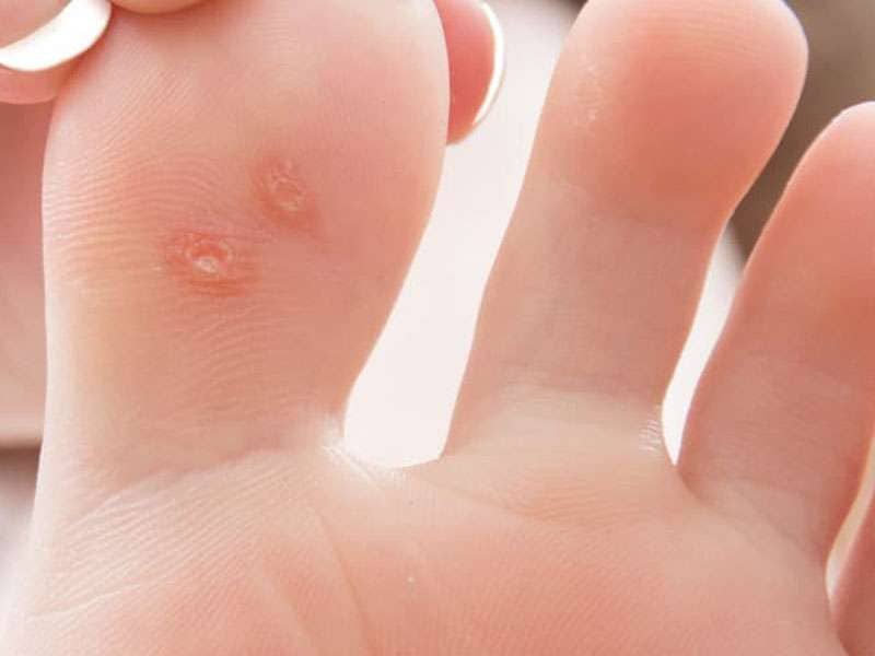 wart treatment recommendations c9 forever